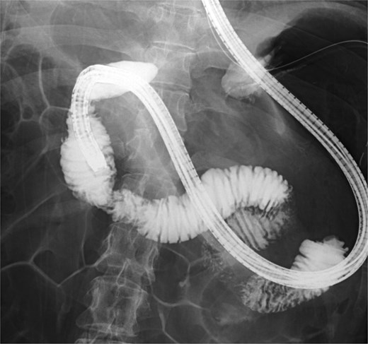 Endoscopic duodenography showing no fixed stenosis or obstructive lesion in the third portion of the duodenum.