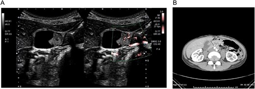 (A) Abdominal ultrasound image showing a 17-mm pedunculated polypoid lesion in the gallbladder body, with color Doppler imaging demonstrating internal blood flow signals. (B) Contrast-enhanced CT scan showing the same gallbladder polyp with arterial enhancement (indicated by an arrow), without signs of inflammation or hemorrhage.