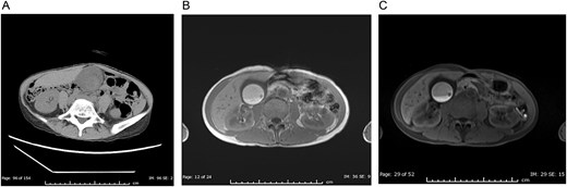 (A) Non-contrast CT showing a markedly distended gallbladder filled with high-density material (92 HU), representing acute intraluminal hemorrhage. (B) T1-weighted MRI showing high signal intensity within the gallbladder, indicating a hematoma. (C) T1-weighted MRI with fat suppression showing that the high-signal area is not suppressed, confirming that the contents are blood rather than fat. The gallbladder polyp is obscured by the hemorrhage in all images.