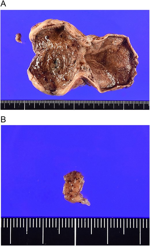 (A, B) Macroscopic photographs of the resected gallbladder specimen after irrigation. The lumen, which was initially filled with a large hematoma, has been cleared to reveal an 8-mm polypoid lesion. The lesion is detached from the gallbladder wall, strongly suggesting it as the source of the hemorrhage.