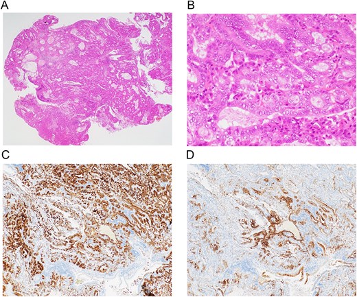 (A) Low-magnification H and E stained image providing an overview of the polypoid lesion. (B) High-magnification H and E stained image (x40) showing a pyloric gland adenoma with mild nuclear atypia and irregular glandular arrangement, without malignancy. (C) Immunohistochemical staining showing diffuse positivity for MUC6 within the tumor cells. (D) Immunohistochemical staining showing partial positivity for MUC5AC. These findings confirm the diagnosis of a pyloric gland adenoma.