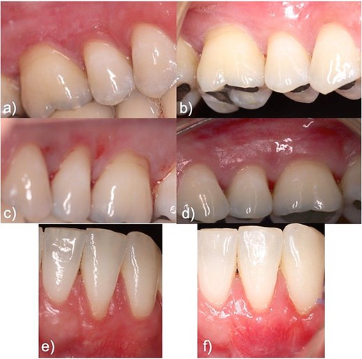 With regard to clinical periodontal parameters, improvements were obtained in probing depths and gains in keratinized gingiva were observed in teeth treated with EMD and PRF.