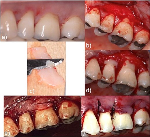 This incision consisted of three interdental sub marginal incisions which, together with an intrasulcular incision at the mesial-distal margins of the recession defects, form the surgical papillae of the envelope flap.