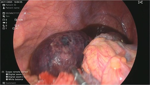 Floating torsioned necrotic gangreneous gallbladder found suspended near thoracic cavity upon laparoscopy.