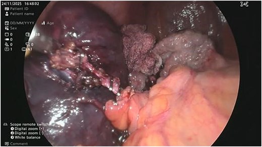 Cystic duct identifies, two clips applied at base and one clip applied proximally and the duct divided.