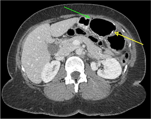 Axial abdominal CT scan showing a 4 cm hake fishbone (lower arrow) and free intraperitoneal air in the abdominal cavity (upper arrow).
