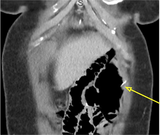 Coronal abdominal CT scan showing the 4 cm hake fishbone (arrow).