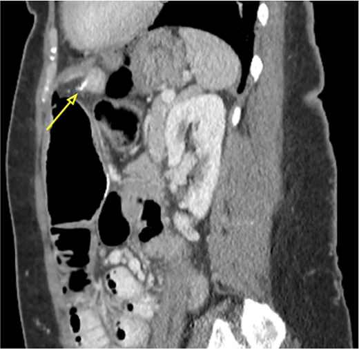 Sagittal abdominal CT scan showing the 4 cm hake fishbone (arrow).