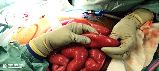 Intraoperative image of small bowel perforation caused by the hake fishbone.