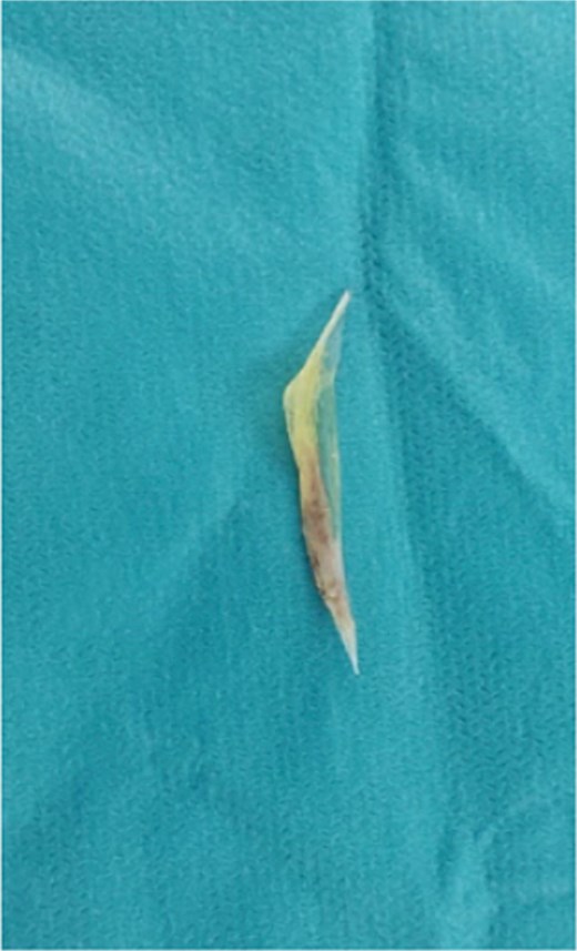 Extracted 4 cm hake fishbone responsible for the double small bowel perforation.
