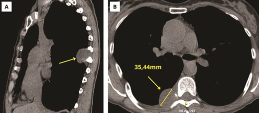 Initial thoracic computed tomography. (A) Sagittal cut. (B) Axial cut.