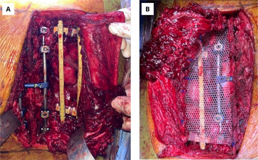 Intraoperative imaging of the thoracic wall reconstruction. (A) Backbone instrumentation and costal arches fixation. (B) Thoracic wall defect repair with prosthetic material.