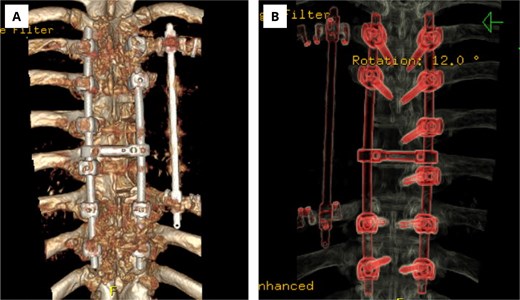 Postoperative computed tomography of the thoracic backbone with three-dimensional reconstruction.