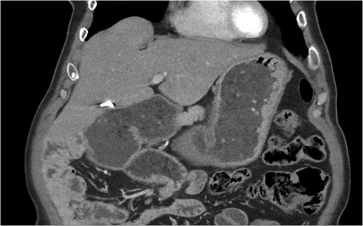 CT imaging with signs of intestinal malrotation associating important gastric and duodenal dilatation with a subsequent change in calibre at the duodenojejunal junction.