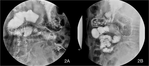Upper gastrointestinal imaging (UGI) contrast series on the third postoperative day showing an absence of stenosis at the duodenojejunal junction with good contrast passage. A residual but less pronounced dilation of the duodenum was still present, but with good peristalsis.