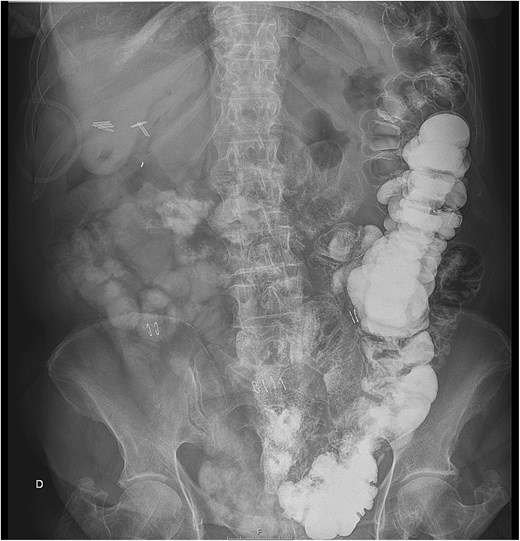 Abdominal radiography on the third postoperative day describing oral contrast on the colon which is entirely on the left side of the abdomen.