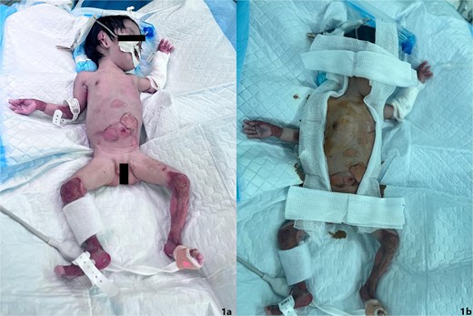 (a) Skin manifestation upon initial resuscitation. Shows widespread bullous lesions and large areas of denuded skin. (b) Pre-operation protective draping.
