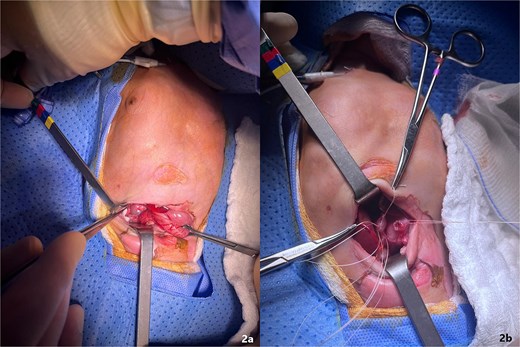 (a) The area of long-segment gastroduodenal atresia. That extends from the distal antrum through the pylorus to the D1–D2 junction. (b) Gastroduodenal bypass anastomosis.