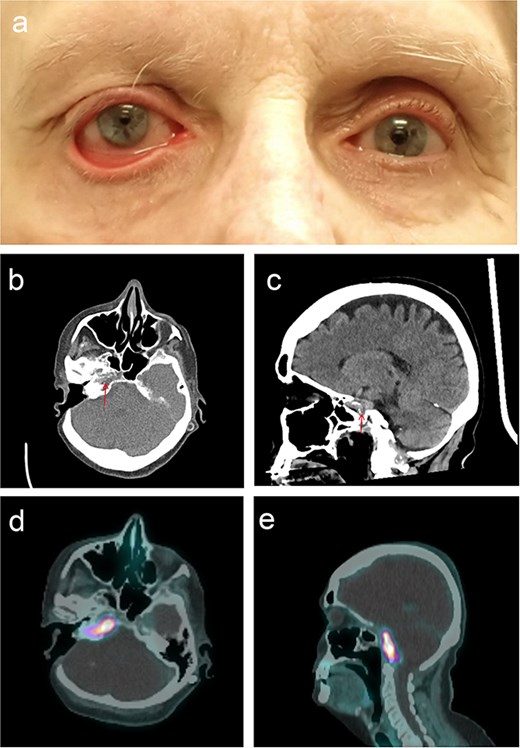 Clinical and radiological features of a recurrent right-sided glomus jugulare tumour. Panel A shows the patient with right-sided facial palsy, lower lid ectropion, and brow ptosis. Panels B and C are computed tomography images of the tumour in axial and sagittal planes, respectively, demonstrating a lesion in the right temporal bone. Panels D and E are positron emission tomography images of the lesion, in the axial, and sagittal planes, showing high tracer uptake.