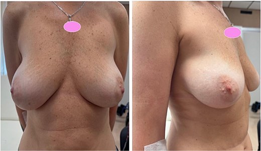 Preoperative frontal ad lateral clinical photographs of a female patient demonstrating breast ptosis and asymmetry prior to bilateral risk-reducing mastectomy with immediate implant-based reconstruction.