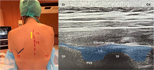 Ultrasound-guided erector spinae plane block showing probe position, anatomical landmarks, and corresponding ultrasound image.