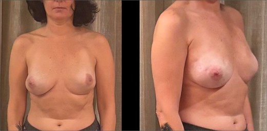 Postoperative frontal and lateral views at 9 months following bilateral mastectomy with implant-based reconstruction; left-sided pacemaker visible.