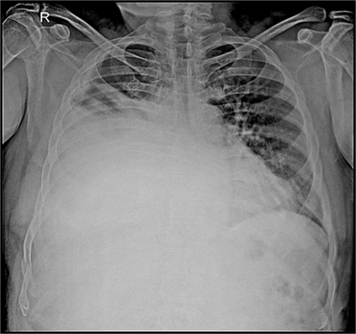 A grayscale chest radiograph showing a large accumulation of air and blood in the left pleural space. The left lung is almost entirely collapsed toward the center of the chest, and a distinct horizontal air-fluid level is visible, indicating the presence of both liquid and gas.