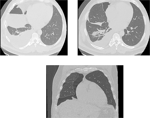A transverse computed tomography (CT) scan of the thorax obtained after a closed thoracostomy. The image reveals a persistent, dense collection of blood (retained hemothorax) in the pleural cavity. Despite the presence of a chest tube, the affected lung remains only partially inflated (incomplete re-expansion), with visible consolidation and fluid displacement within the chest wall.