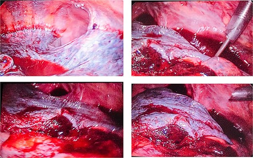 An internal intraoperative view through a thoracoscope showing the pleural space filled with organized, solid blood clots. Thick fibrous bands (pleuropulmonary adhesions) are visible extending between the lung surface and the chest wall, physically restricting the lung and preventing it from expanding, a condition known as trapped lung.