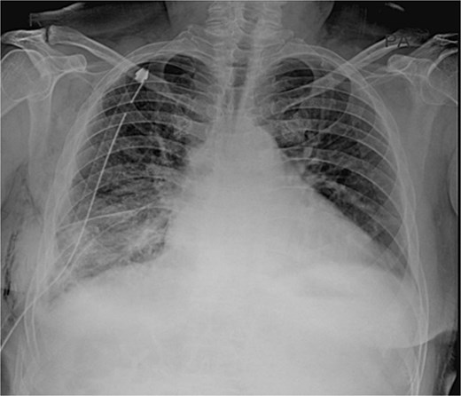 Postoperative chest radiograph showing the successful result of a thoracoscopic release. The previously collapsed lung is now fully inflated, filling the entire left thoracic cavity (complete re-expansion). The pleural space is clear of fluid and air collections, and the diaphragm and heart borders are clearly defined.