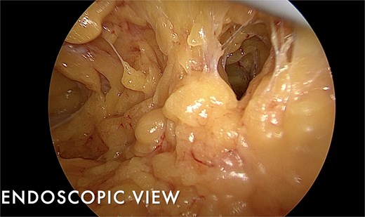 Endoscopic intraoperative view showing subcutaneous flap dissection during nipple-sparing mastectomy, with clear visualization of Cooper's ligaments and preserved skin and nipple-areolar complex vascularity.