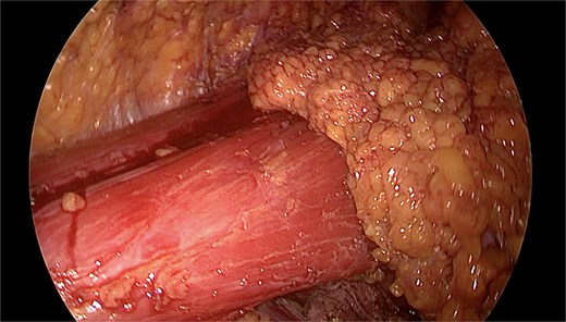 Endoscopic intraoperative view showing identification of the pectoralis major muscle during subfascial dissection, with exposed muscle fibres and preserved chest wall integrity.