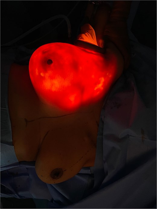Intraoperative transillumination view demonstrating uniform light transmission through the mastectomy flap with a well-perfused nipple-areolar complex.