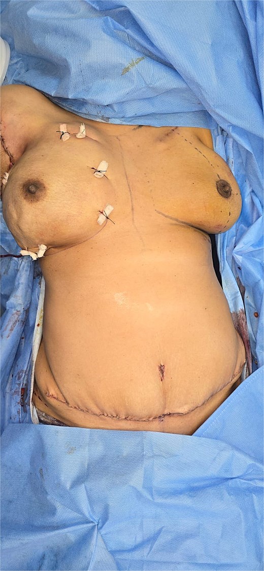 Postoperative view showing reconstructed breast following nipple-sparing mastectomy with DIEP flap and a well-healed abdominal donor site incision.