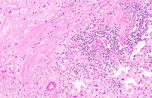 Histopathological image (H and E stain) showing tumour bed fibrosis with inflammatory cell infiltrate and hemosiderin-laden macrophages, with no residual invasive or in situ carcinoma.