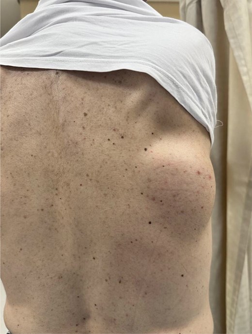 Firm, mobile, well-circumscribed 10 cm mass in the right infrascapular region, more prominent on shoulder abduction; overlying skin normal