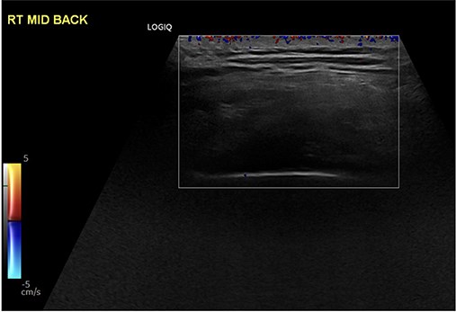 Gray-scale ultrasonography of the right subscapular region demonstrating a heterogeneous, poorly circumscribed soft-tissue mass with alternating hyperechoic and hypoechoic linear areas, consistent with a fibrofatty lesion.