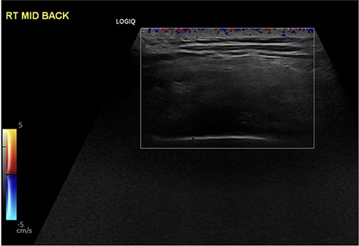 Color Doppler ultrasonography showing minimal internal vascularity within the right subscapular mass, supporting a benign etiology.