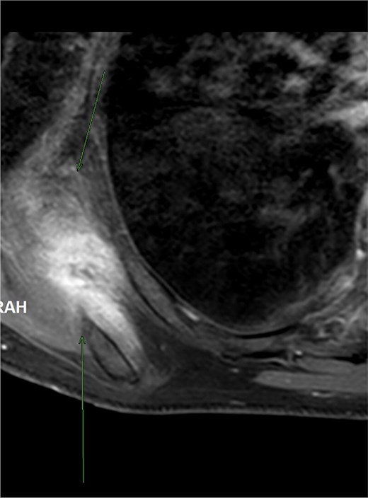 Axial T2-weighted fat-suppressed MRI demonstrating a poorly circumscribed mass in the right infrascapular region with a striated appearance due to alternating fibrous and fatty components.