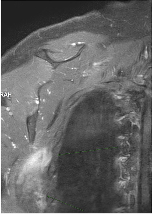 Contrast-enhanced axial MRI showing mild heterogeneous enhancement of the right subscapular lesion without aggressive features, consistent with elastofibroma dorsi.