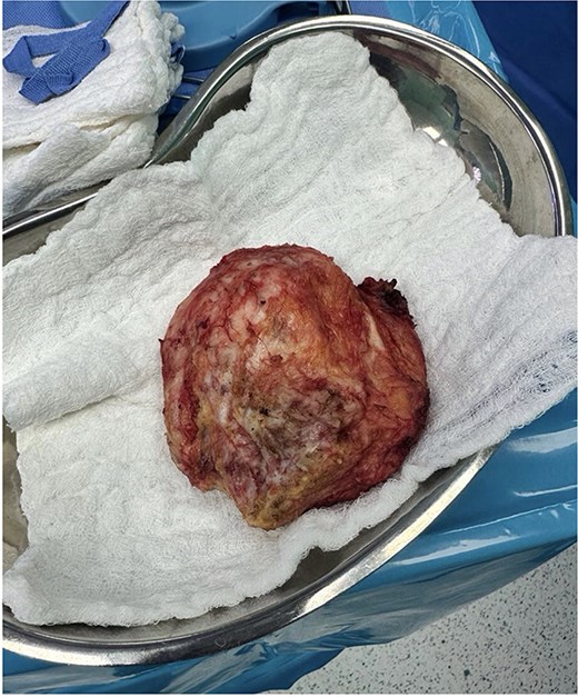 Contrast-enhanced coronal MRI demonstrating the craniocaudal extent of the right infrascapular mass located between the scapula and chest wall, with preservation of adjacent structures.