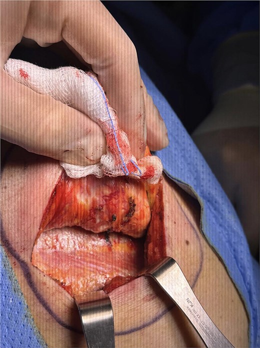 Intraoperative appearance of a firm, oval, unencapsulated 7 cm mass deep to the scapula, surrounded by subscapularis, latissimus dorsi, and serratus