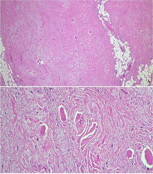 Histopathological examination (hematoxylin and eosin stain) revealing dense collagenous tissue containing abnormal elastic fibers interspersed with mature adipose tissue, confirming the diagnosis of elastofibroma dorsi.