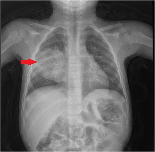 Chest radiograph showing consolidation in the right upper and middle lobes of the lung.