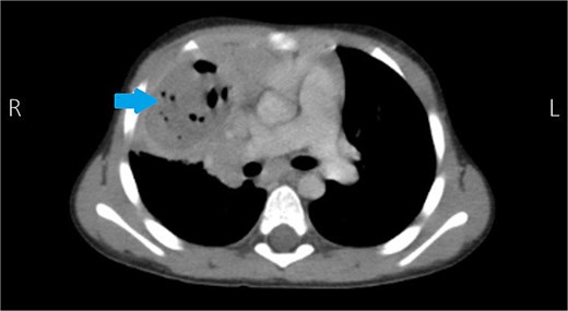 Contrast-enhanced CT scan showing a cavitary lesion in the right upper lobe, consistent with a ruptured hydatid cyst.