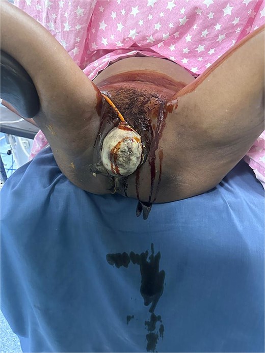 Preoperative image demonstrating stage IV pelvic organ prolapse with circumferential full-thickness vaginal necrosis secondary to thermal injury.