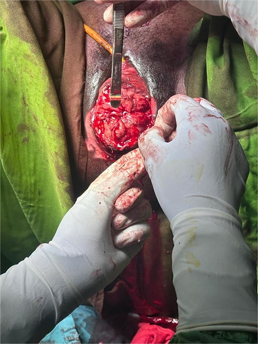 Intraoperative view following extensive debridement showing viable bleeding tissue margins.