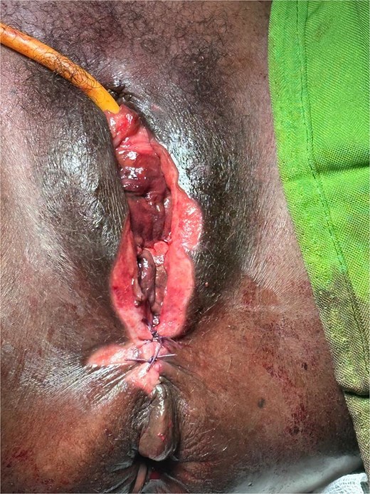 Immediate postoperative appearance after colpocleisis demonstrating obliteration of the vaginal canal.