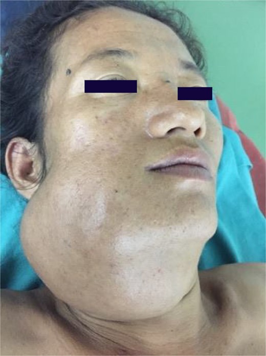 Preoperative clinical photograph showing diffuse swelling over the right mandibular region, causing facial asymmetry.