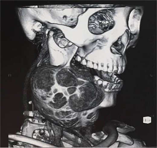Preoperative computed tomography three-dimensional reconstruction showing the extent of mandibular involvement.